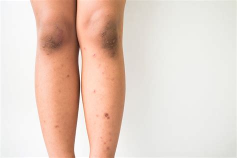dark spots on legs from scratching